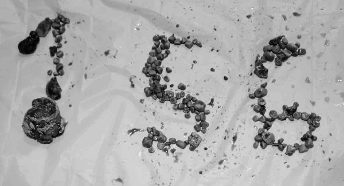 156 kidney stones removed from a patient