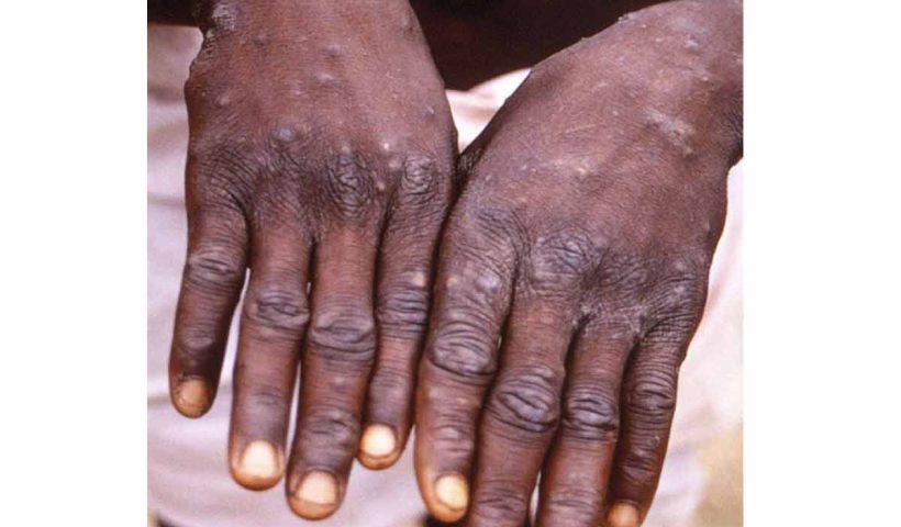 Delhi: Three Private Hospitals Ordered To Create Isolation Rooms For Monkeypox