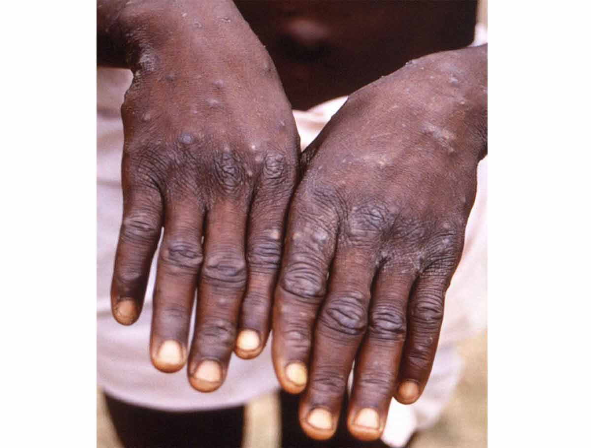 US Reports First Confirmed Case Of Monkeypox