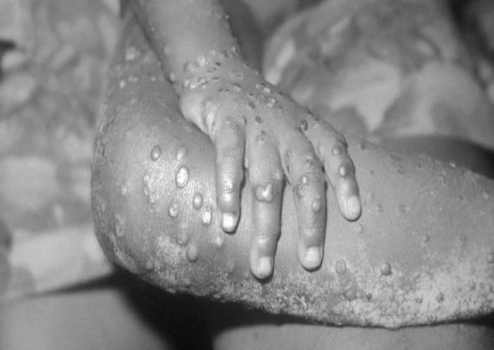 Monkeypox: First Case Reported In Israel