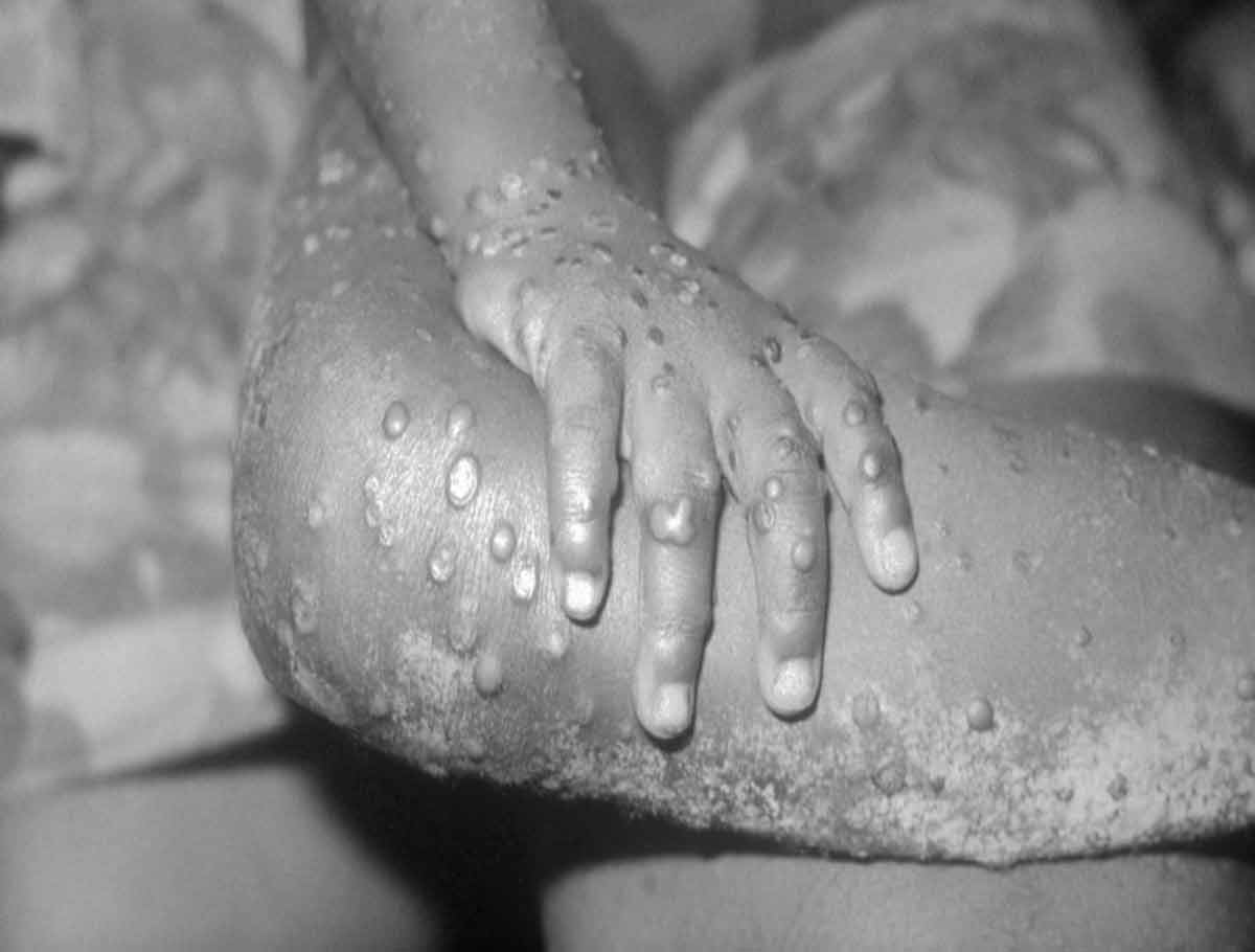 Monkeypox: First Case Reported In Israel
