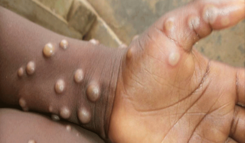 First Death Case of Monkeypox Reported in Kerala