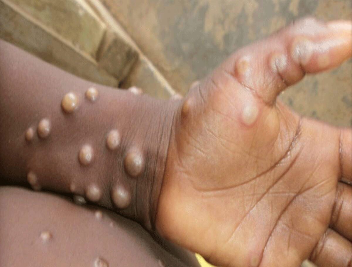 First Death Case of Monkeypox Reported in Kerala