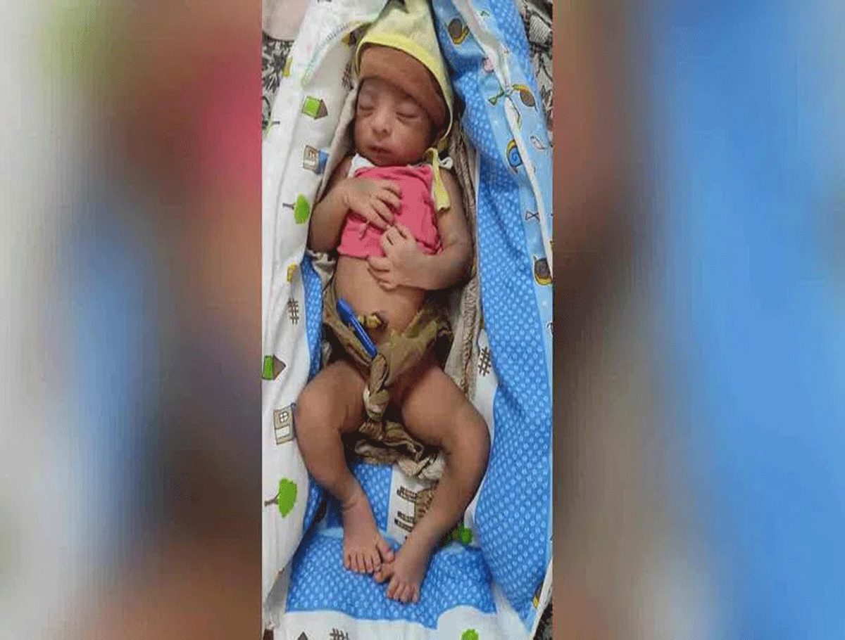 Baby Born With 12 Fingers and 12 Toes in Jagtial