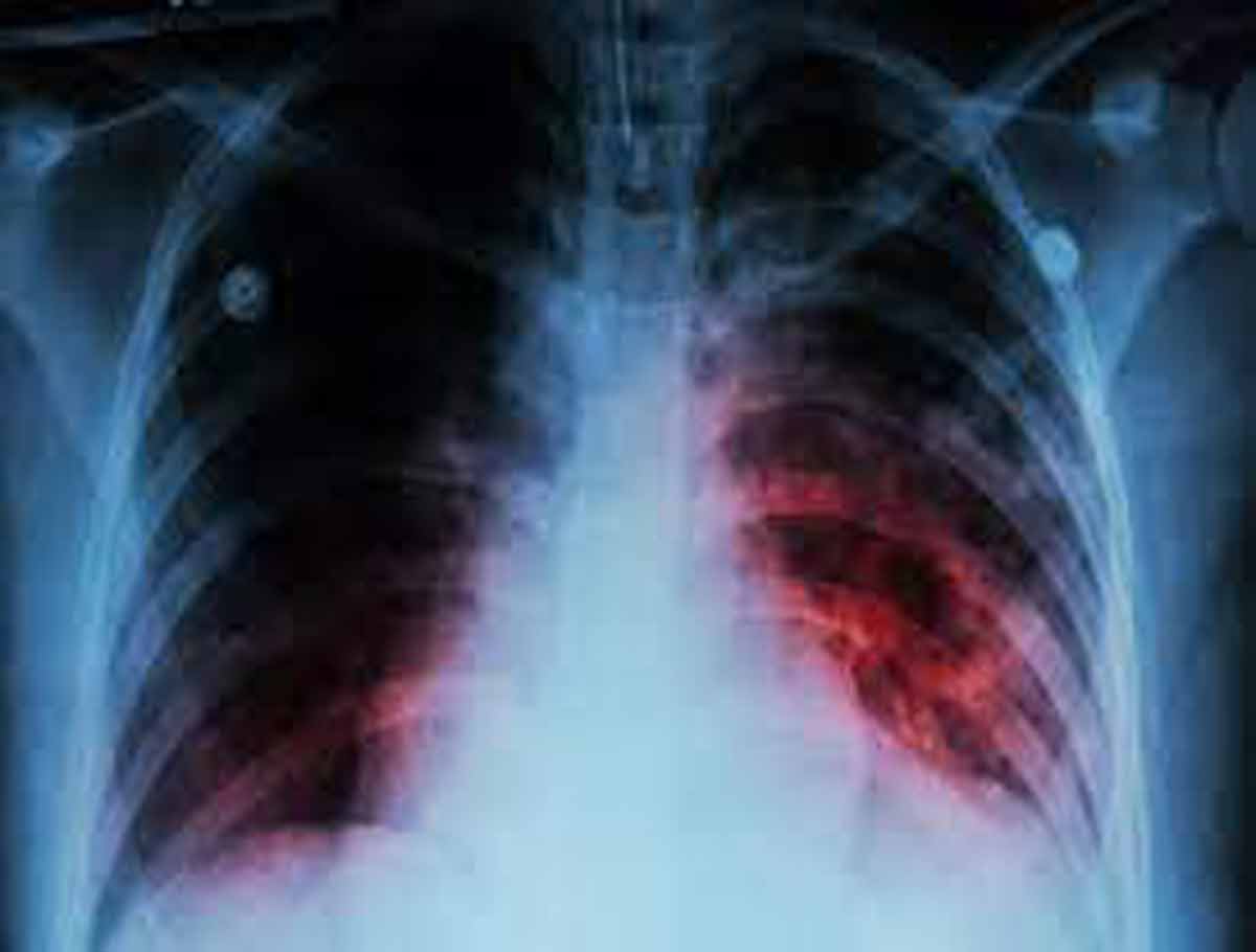 UP Records 3,959 New TB Cases
